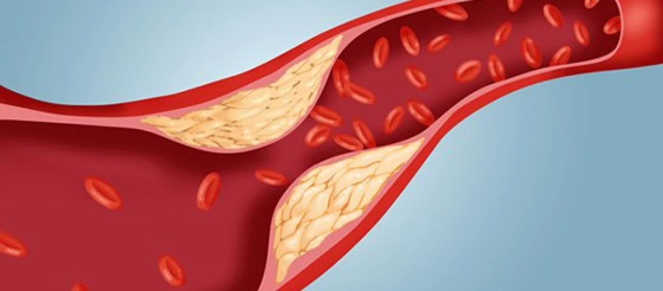 Στένωση αρτηριών: Δείτε τι πρέπει να καταναλώνετε και τι να αποφεύγετε